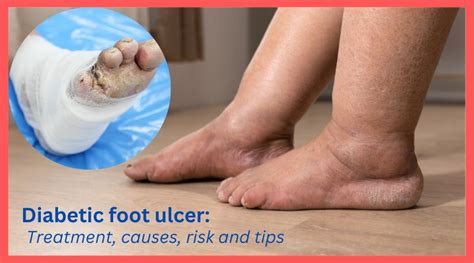 Diabetic Foot Ulcer Treatment Causes Risk And Tips