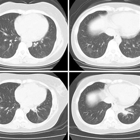 Figure1a B Chest Ct Scan Showing Ground Glass Opacities And Small Download Scientific