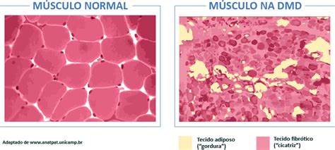 O Que É Distrofia Muscular