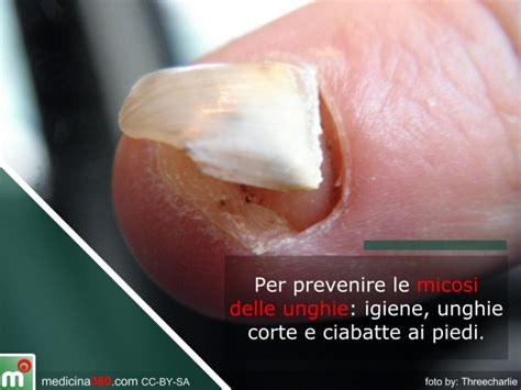 Micosi Delle Unghie Di Mani E Piedi Cause Cure E Rischi Dell Onicomicosi