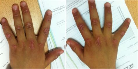 Figure Gottron S Papules On Both Hands Juvenile Dermatomyositis