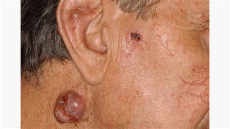 Basal Cell Carcinoma Late Stages