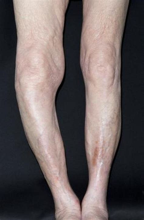 Paget Disease of Bone - Bone, Joint, and Muscle Disorders - Merck
