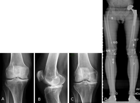 Gonarthrose F Moro Tibiale La Revue Du Praticien