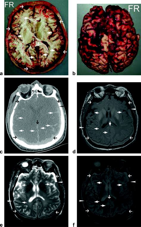 Traumatic Extraaxial Hemorrhage Correlation Of Postmortem Msct Mri