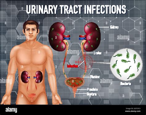 Informative Illustration Of Urinary Tract Infections Stock Vector Image