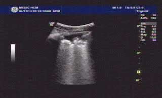 VIETNAMESE MEDIC ULTRASOUND: CASE 224: LEFT SUPRACLAVICULAR MASS, Dr ...