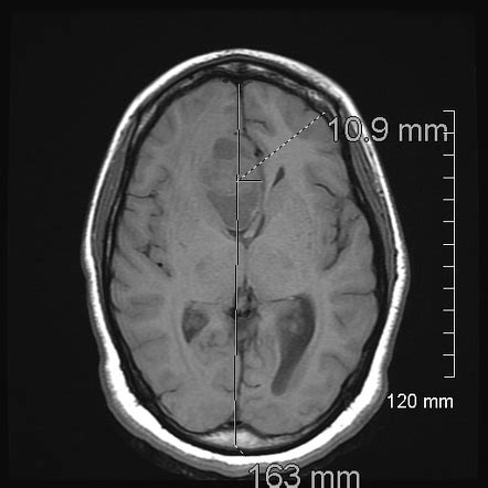 Rhabdoid Meningioma Image Radiopaedia Org