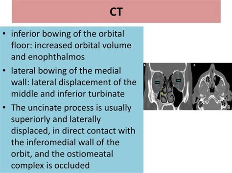 Silent Sinus Syndrome In The Eye Of A Radiologist Ppt