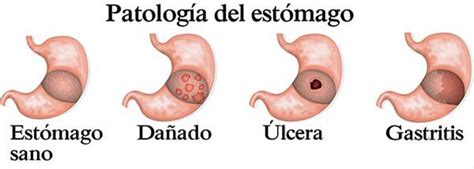 Problemas En EstÓmago Instituto MacrobiÓtico De Andalucia