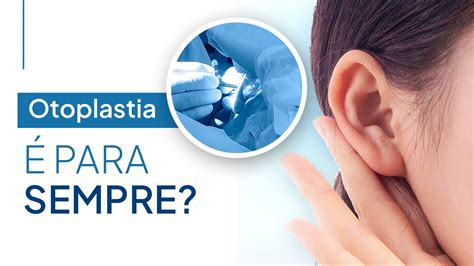 Otoplastia Para Sempre Recidiva Orelha De Abano T Cnica