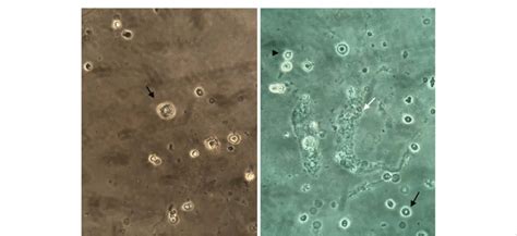 Urine microscopy (400x). (A) Renal tubular epithelial cell; (B ...