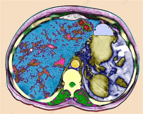 Secondary Liver Cancer Ct Scan Stock Image M1340538 Science Photo Library