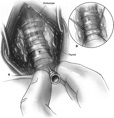 Thoracic Surgery Techniques In Open Tracheal Surgery For Tracheal