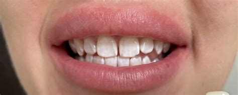 Отбеливание зубов. Солигорск. Magic Smile | Отбеливание зубов БЕЗ БОЛИ ...