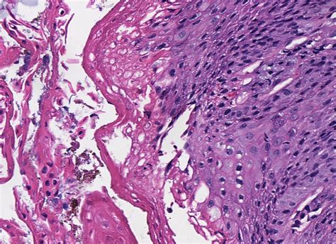 Pathology Outlines Esophagitis Dissecans Superficialis