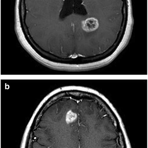 Patient Imaging Mri Showing A Initial Right Frontal Glioblastoma