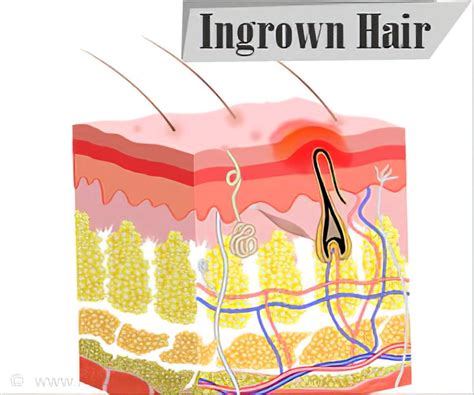 Share 140 Reasons For Ingrown Hair Latest POPPY