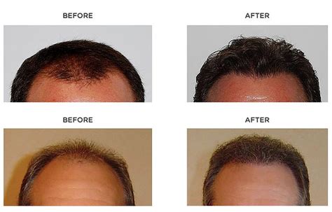 Can you regrow hair after genetic hair loss | Hair Sure