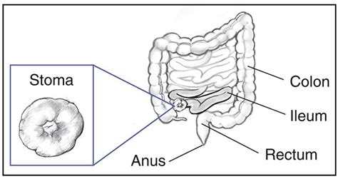 Types Of Ostomy Surgery Of The Bowel Niddk