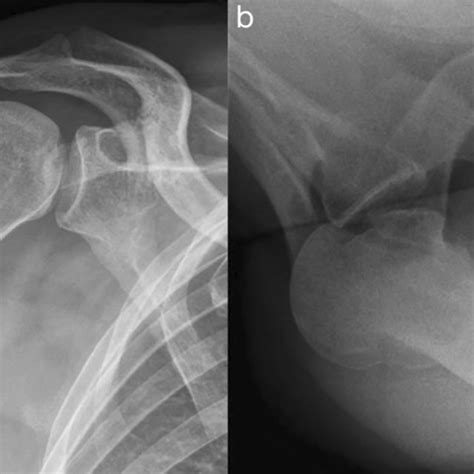 Treatment algorithm for posterior shoulder dislocation depending on the... | Download Scientific ...