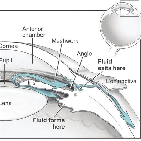 Postoperative Complications in Ahmed Glaucoma Valve Group | Download Table