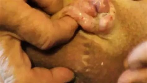Penectomy Porn Videos Gay XXX XHamster