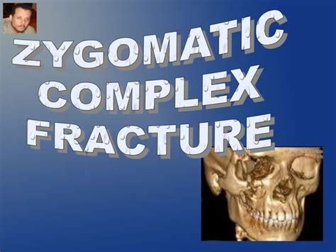 Zygomatic Complex Fracture Ppt