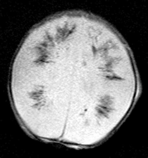 Structure Of The Medullary Veins Of The Cerebral Hemisphere And Related