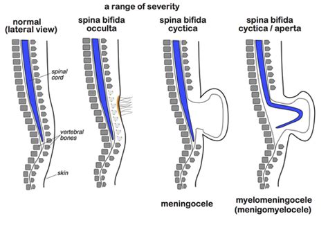 Spina Bifida Occulta In Adults