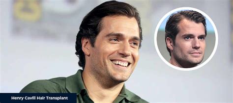 Henry Cavill Hair Transplant - Smile Hair Clinic