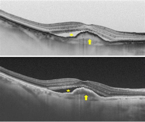 Optical Coherence Tomography In Age Related Macular Degeneration