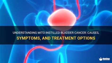 Understanding Mito Instilled Bladder Cancer Causes Symptoms And Treatment Options Medshun