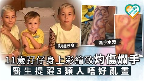 【彩繪紋身】11歲孖仔身上彩繪致灼傷爛手 醫生提醒3類人唔好亂紋 晴報 健康 皮膚護理 D191106