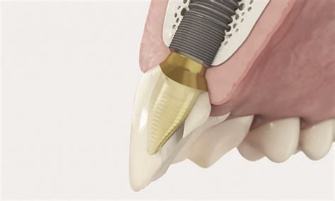 CEREC Implantology Discover Now Dentsply Sirona