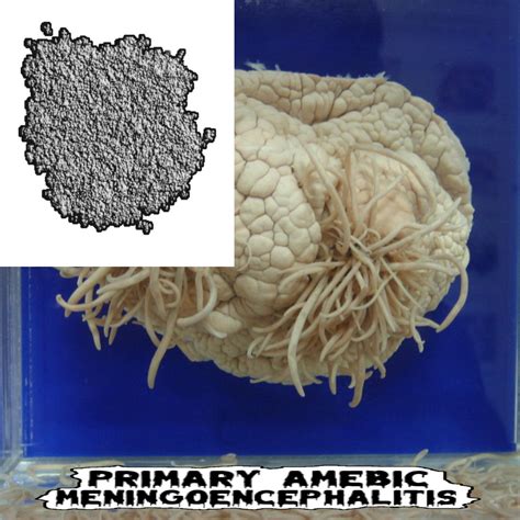 Naegleria Fowleri Primary Amebic Meningoencephalits Pathological Menace Productions