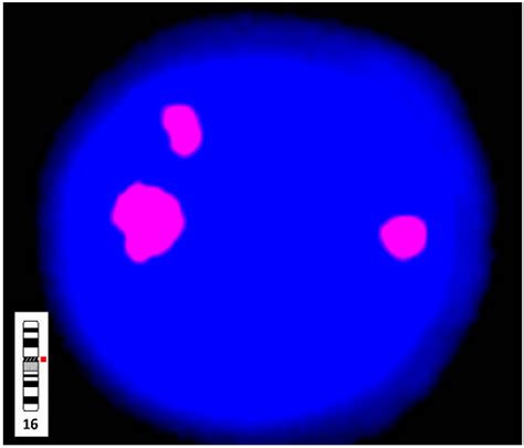 Prenatal Diagnosis Of True Fetal Mosaicism With Small Supernumerary Marker Chromosome Derived