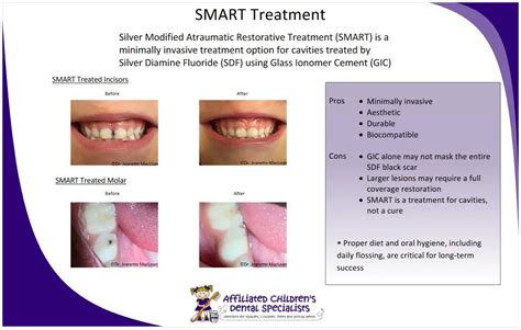 Silver Diamine Fluoride (SDF) - Rebecca Testa Pediatric Dentistry