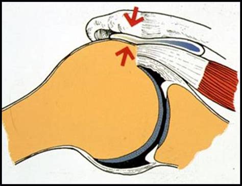 Conflit Sous Acromial Acromioplastie Chirurgiens Orthop Distes