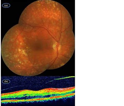 Simultaneous Intravitreal Ranibizumab And Dexamethasone Implant Administration At The Same