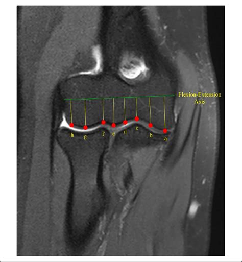 Determined Points For The Measurement Of Cartilage Thickness And Bone