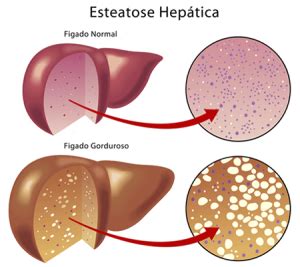 O Que Significa Esteatose - Esteatose hepática Dr. Vinícius Pelloso