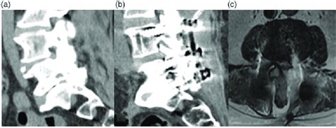 Main Causes Of Contralateral Radiculopathy A Previous Preoperative