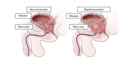 Prof Dr A R G Neri Prostat Nedir Nas L Tedavi Edilir