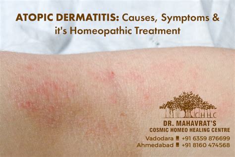 Atopic Dermatitis Causes Symptoms And Its Homeopathic Treatment