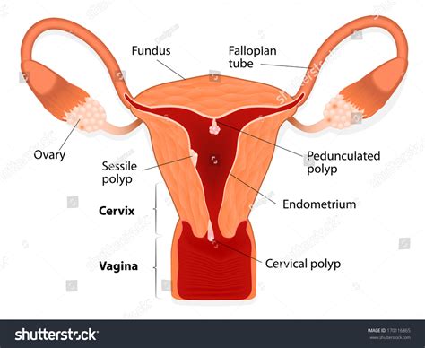 Endometrial Polyp Or Uterine Polyp. Sessile Polyp And Pedunculated ...