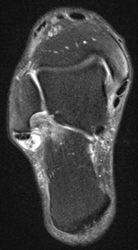 Rupture of the peroneus brevis tendon (MRI oblique axial view). | Download Scientific Diagram