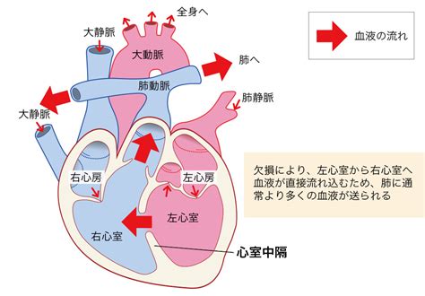 先天性心疾患の病態、血流動態まとめ｜医学的見地から