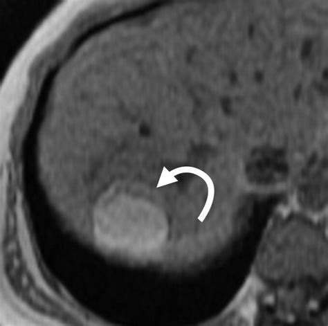 Comprehensive Imaging Manifestations Of Tuberous Sclerosis Ajr