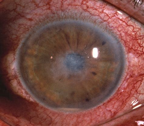 Microsporidial Stromal Keratitis Cornea Jama Ophthalmology The